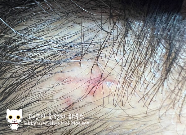  남편인생 첫 성형수술 후기 - 4. 내시경이마거상술+추미근 절제 후기(9일차 ~ 25일차 후기)