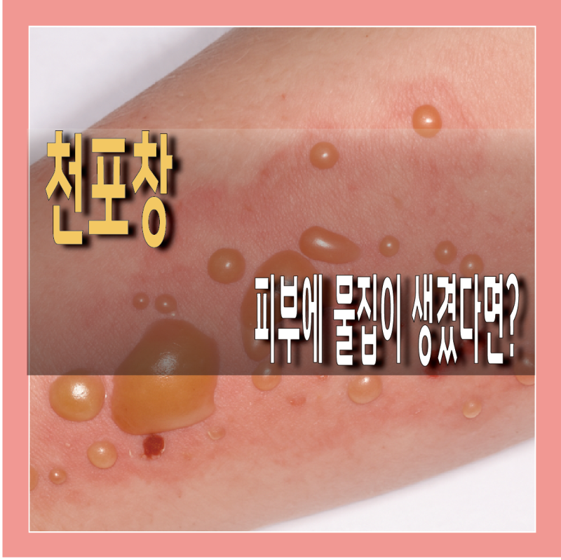 유사 천포창 전염 원인 A to Z