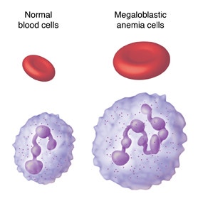 거대 적혈모구빈혈 (Megaloblastic anemia), 엽산 결핍, 비타민B12 결핍