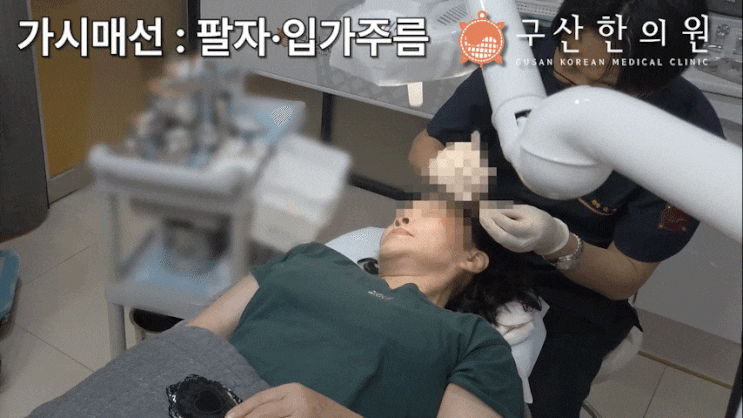  포항 한의원 가시매선, 수술 없이 1년 효과? 23년 노하우로 증명합니다