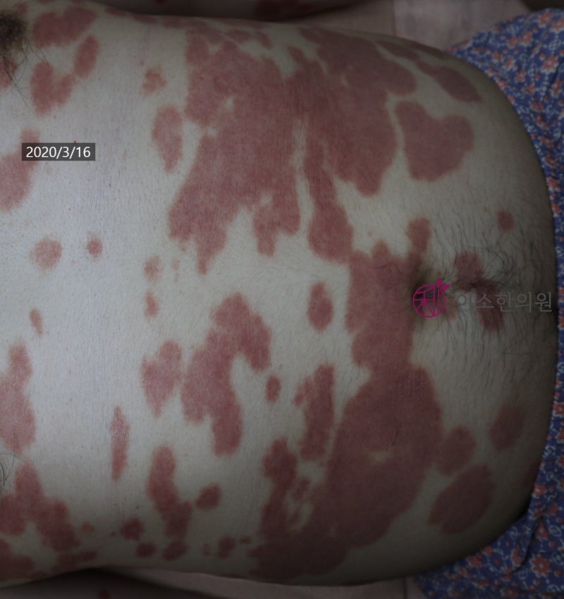 노원 건선, 감기 후 피부 각질, 붉어짐? 물방울 건선(Guttate psoriasis)