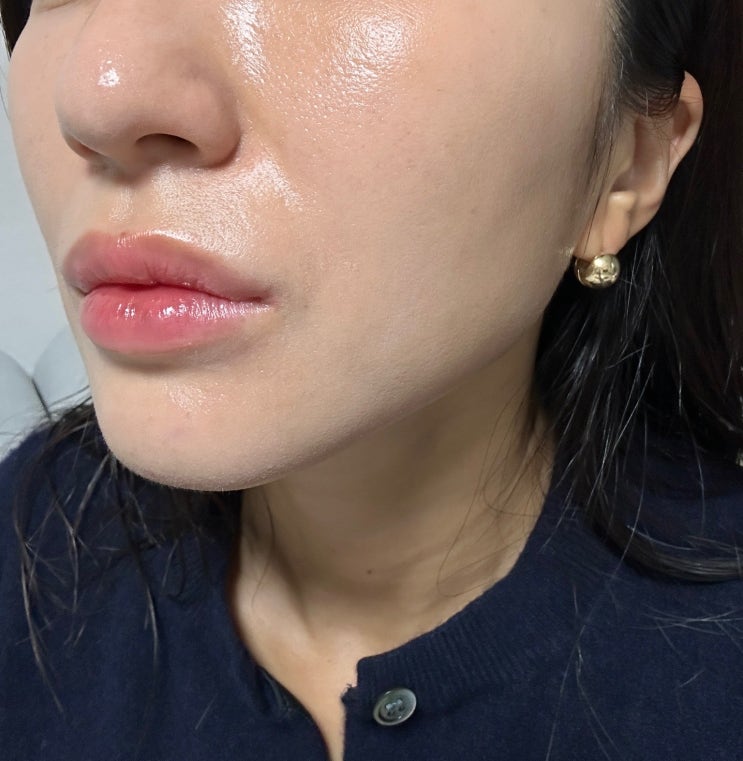  강남 신사역피부과 리쥬란힐러 효과 후기(리쥬란 리쥬란힐러 차이점)