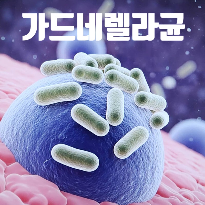 가드네렐라균 걱정된다면? 주요 원인 증상 치료 방법