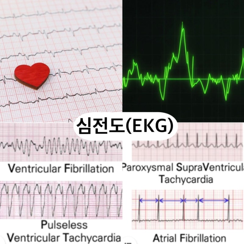 심전도 보는 법 완벽 가이드 — 파형 의미 + 응급 리듬 완전 분석