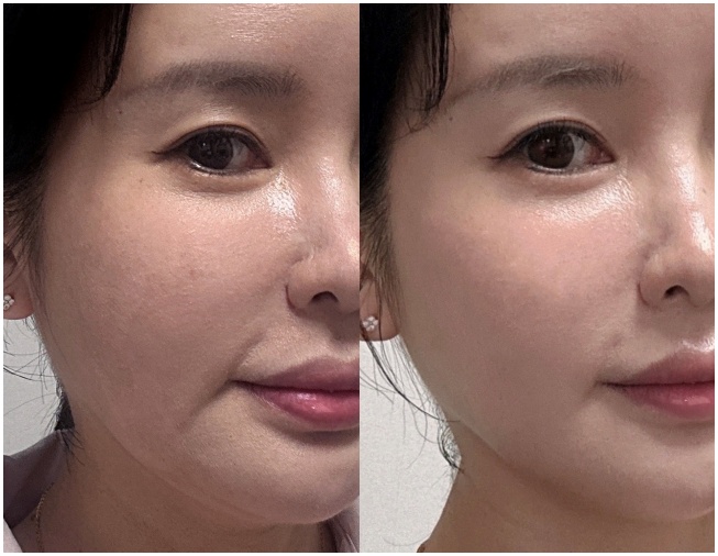  부산 서면 피부과 40대 처진 얼굴 고민 해결 올타이트리프팅 후기!