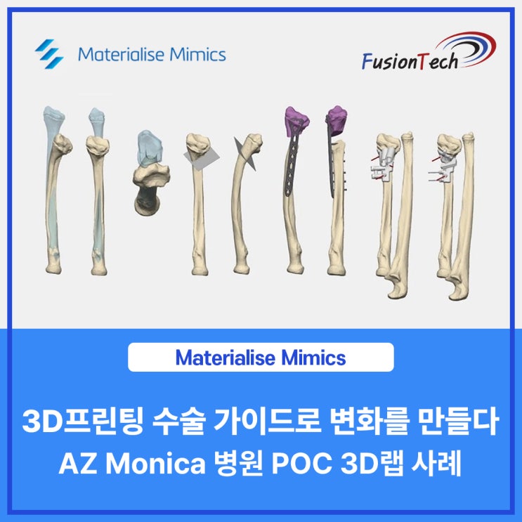  [Materialise S/W] 3D 프린팅 수술 가이드로 변화를 만들다 – AZ Monica 병원 이야기