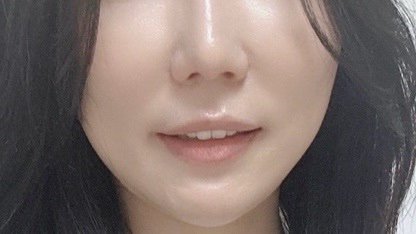  넓어진 모공 고민, 피부과 관리 큐어젯 모공 시술 후기