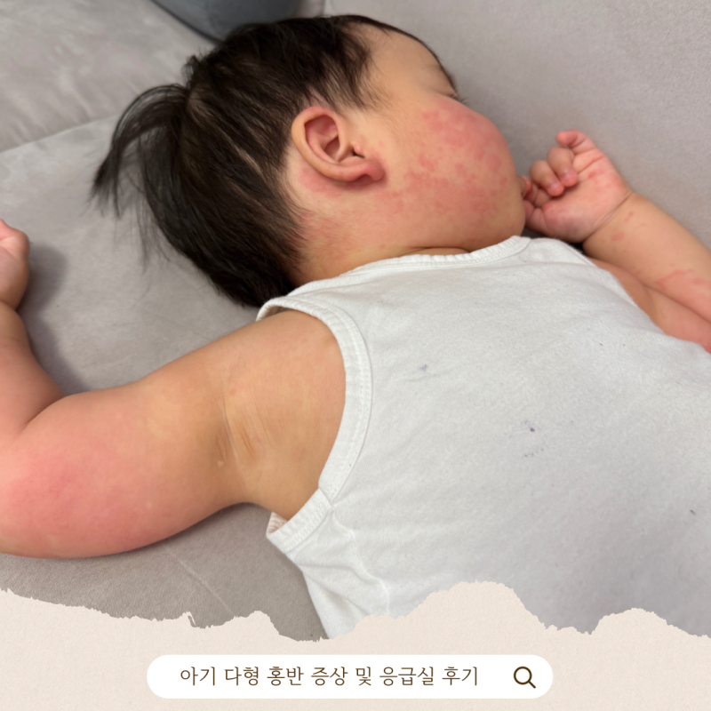 아기 두드러기 피부 붉은 반점 다형 홍반 증상 및 응급실 후기