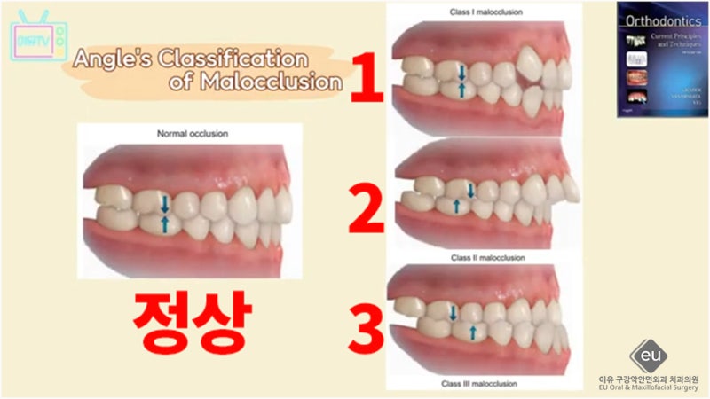 부정교합종류 양악수술교정 강남역구강악안면외과