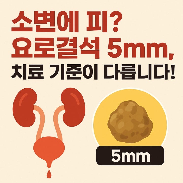 요로결석 크기에 따라 다른 치료법 – 5mm 기준의 비밀