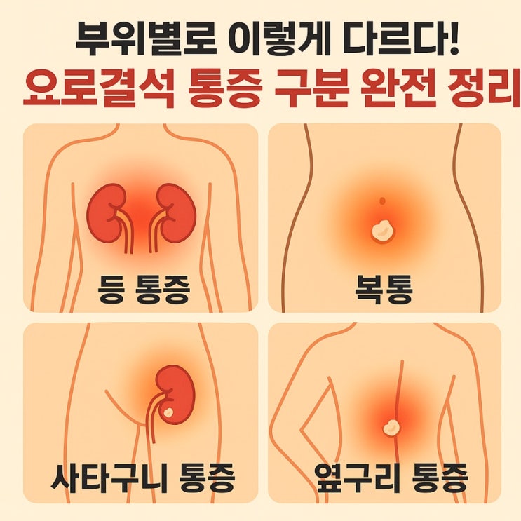  요로결석, 위치 따라 증상도 다르다 신장·요관·방광·요도별 통증 구분법