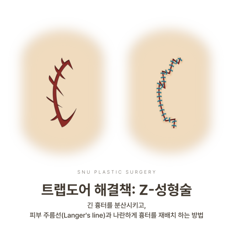  [청담 스누성형외과] 트랩도어 흉터, Z-성형술로 해결