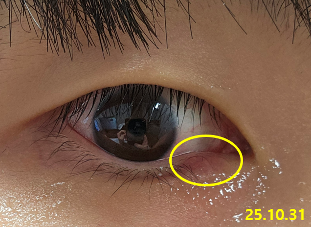 다래끼 빨리 낫는법 째지않고 치료하기 다래끼약