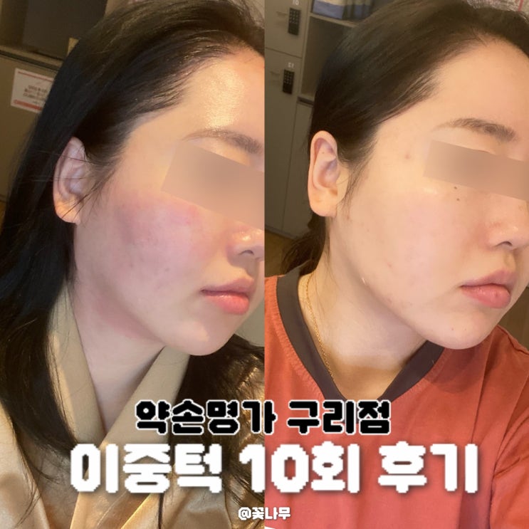  약손명가 구리점 10회 후기 얼굴형 이중턱 팔자주름 전후 비교