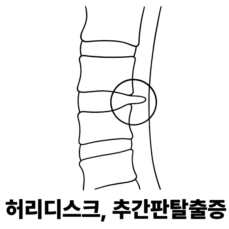  앉을 때마다 다리가 저려요... 혹시 디스크일까요?