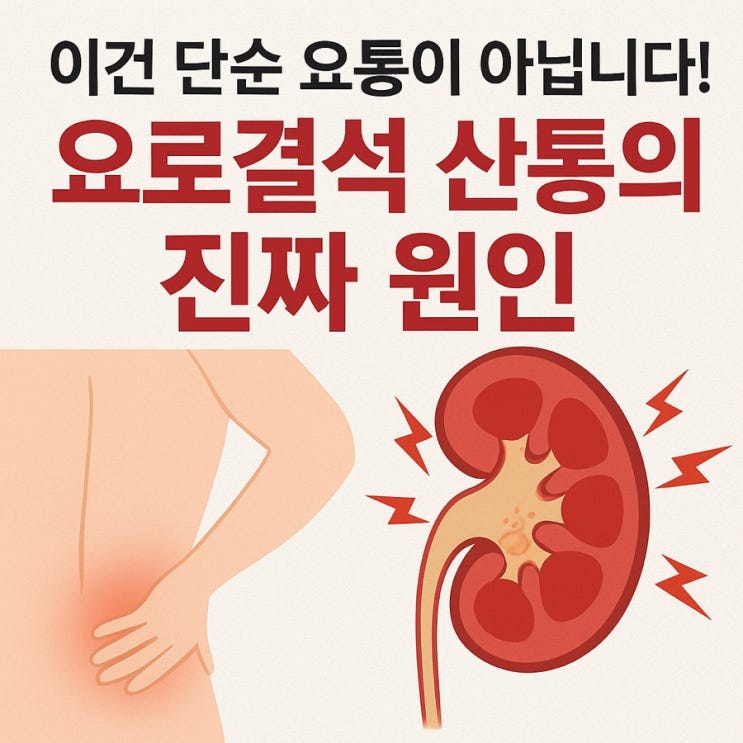  요로결석 통증이 극심한 이유 ‘산통’이란 무엇일까?