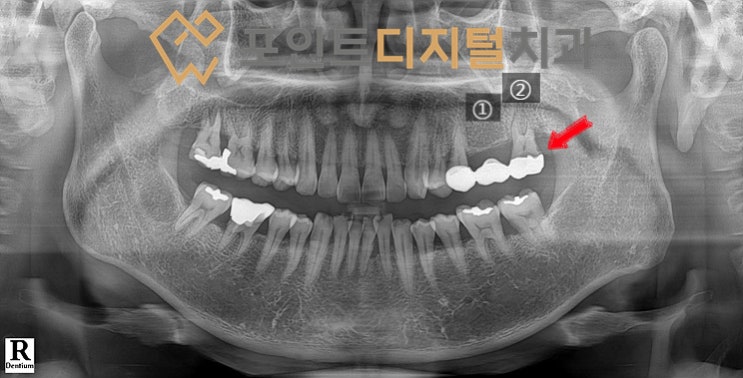  [탕정치과]  충치로 발치(발치즉시 임플란트) + 디지털 가이드 + 하이니스 디지털 보철 / 천안 아산 불당 배방