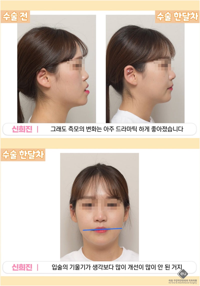 돌출입수술 비용 입툭튀원인 교정 후기 병원