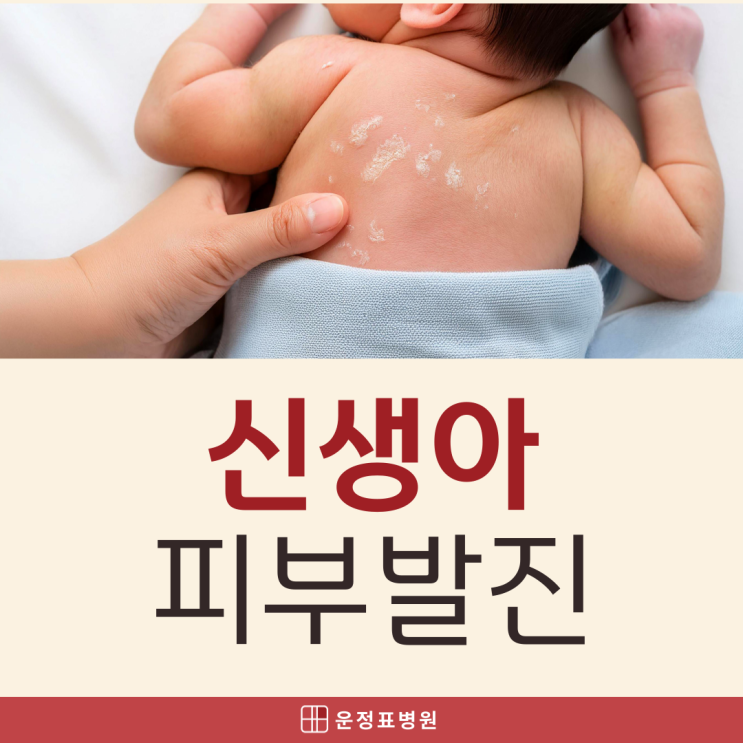  파주 운정소아과 신생아 얼굴 빨간 이유? 소아 피부 발진 총정리