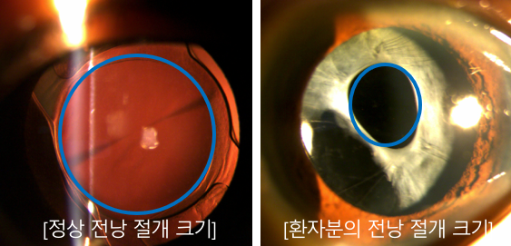  백내장 수술 후 복시? 겹쳐보이는 이유 3가지 <사례>