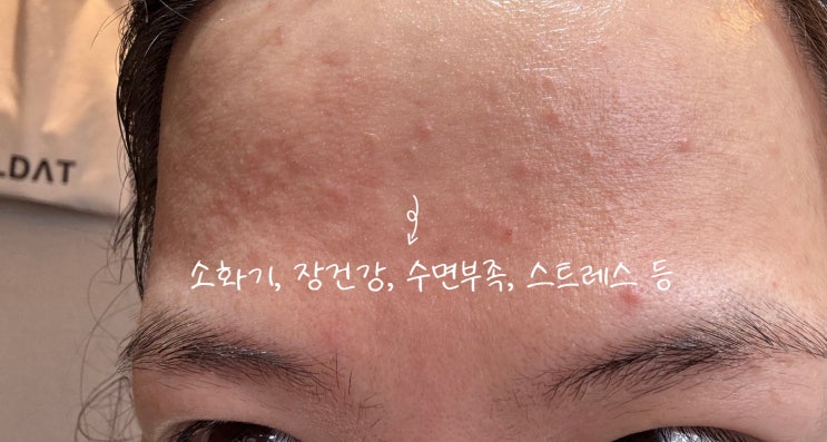  가을 환절기 피부 비상으로 진정피부 100억 유산균으로 트러블 관리 팁과 이마여드름 등 부위별 여드름 원인 분석