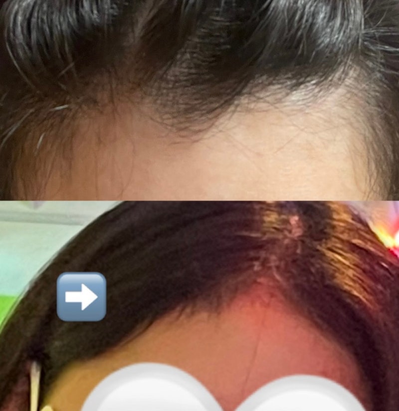 M자이마 고민해결, 발모제 아닌데 머리 난 세럼? 리바이탈래쉬헤어세럼 18통째 재구매한 이유....
