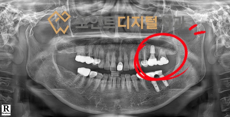  [탕정치과]  iGBR(급속골이식) + PDRN(연어주사) + 디지털 가이드 + 비절개(Flapless) 임플란트 / 천안 아산