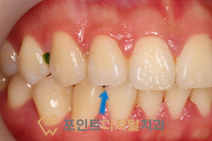  [탕정치과]  앞니 치아파절 레진 수복 케이스 / 천안 아산