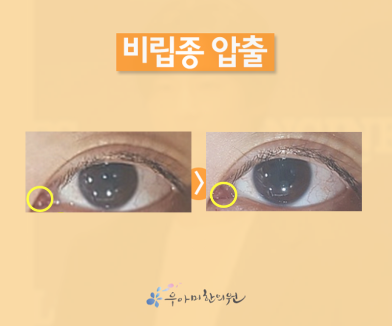 눈앞머리 비립종 압출 피부과 레이저 제거와 어떻게 다른가요?