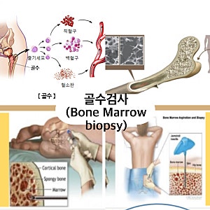 골수검사로 알 수 있는 진짜 피의 이야기— Bone Marrow Biopsy, MDS, 재생불량성빈혈,조혈모세포 ....
