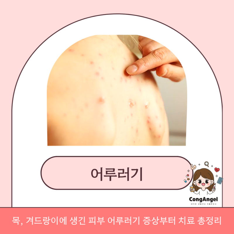 목, 겨드랑이에 생긴 피부 어루러기 증상부터 치료 총정리