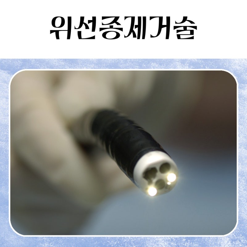 위암 예방의 첫걸음 위선종제거술