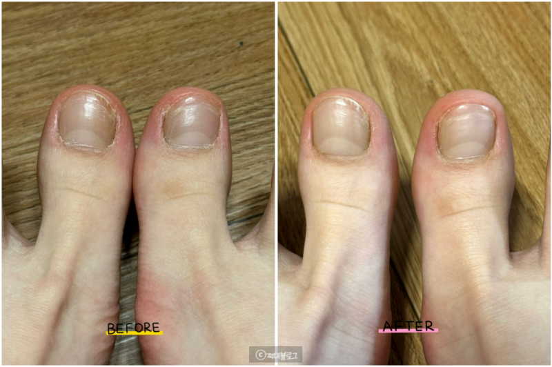 울퉁불퉁한 손발톱변색 발톱 케어에 도움됐던 케라셀 패치