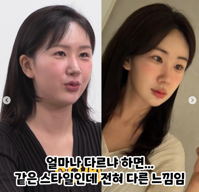  여의도피부과 새로운 리프팅 시술? <올타이트>