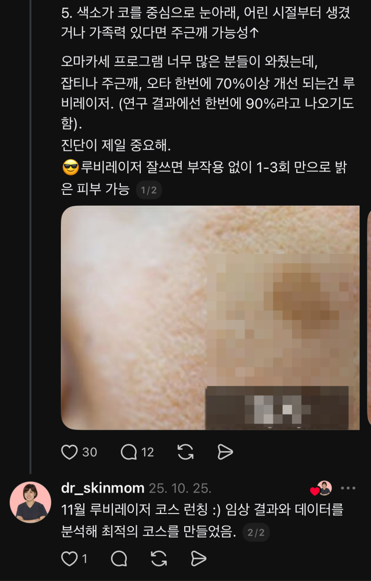  서울흑자제거 루비레이저도 괜찮죠