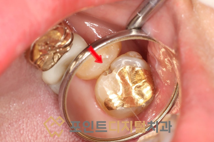  [탕정치과]  치아파절부위 크라운 대신 레진으로 치료하기 / 천안 아산