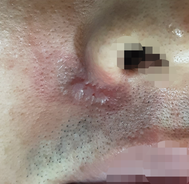 코 주변의 켈로이드성 흉터는 어떻게 치료하나요?