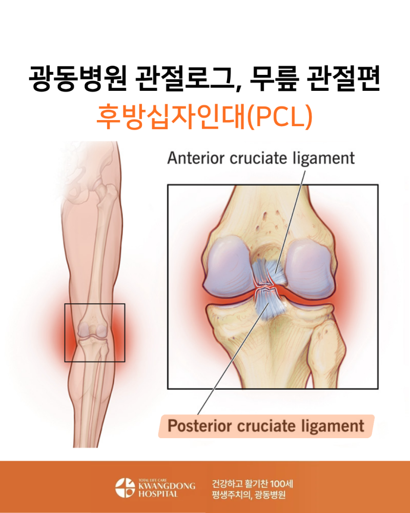 후방십자인대 파열 증상/원인, 강남 재활병원 입원