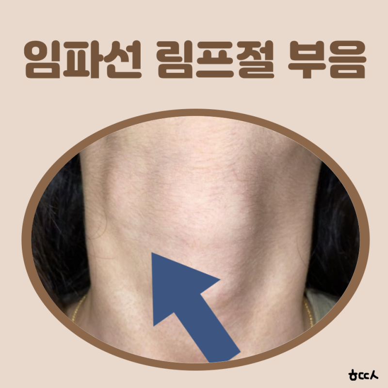 임파선 림프절 차이 목 임파선 위치 임파선 부었을때 임파선 멍울 목 임파선암 초기증상