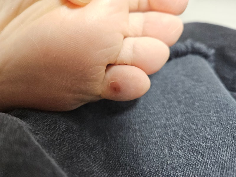 족저사마귀 완치 후기! 2번 냉동치료과정