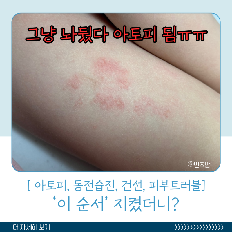 아기 아토피초기 건선 동전습진? 신생아 피부 오돌토돌 원인 연고 비판텐