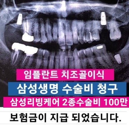 삼성생명 임플란트 치조골이식 (2종) 수술비 100만원 청구_삼성리빙케어 종신보험/삼성생명 ....