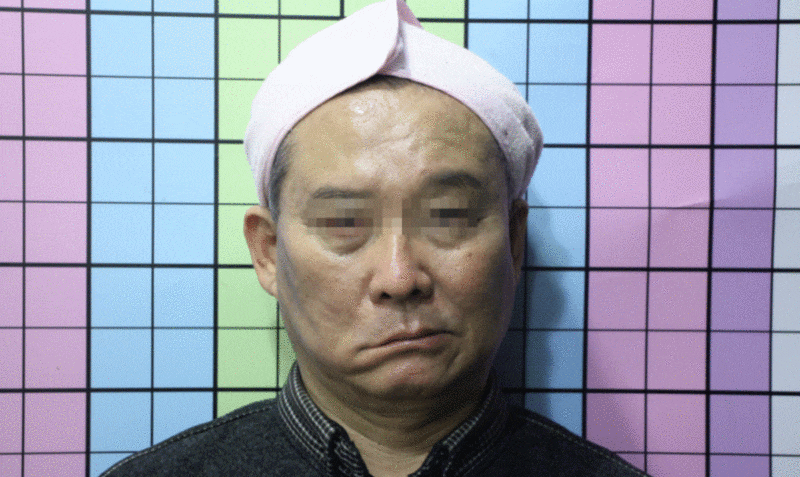 부산 안면마비 한의원 후유증? 3개월, 9개월, 4년 후 변화