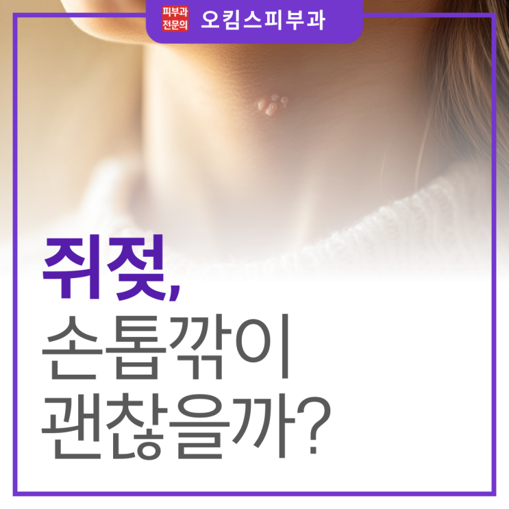  일산 마두역 피부과, 쥐젖 손톱깎이 제거해도 괜찮을까?