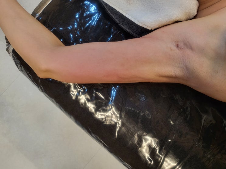  팔 지방흡입 바본, 딱딱한 팔을 부드럽게 회복시키는 관리 전후