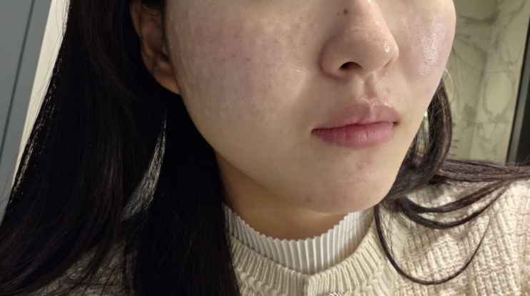  수서역피부과 리쥬란+물광 후기(엠보, 멍, 통증)