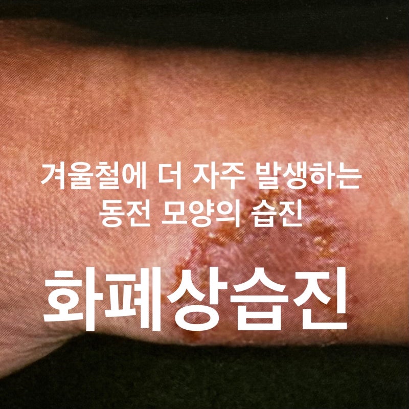 대구 칠곡피부과 화폐상 습진 동전피부염 치료 원인 증상까지, 장재원 피부과 의원