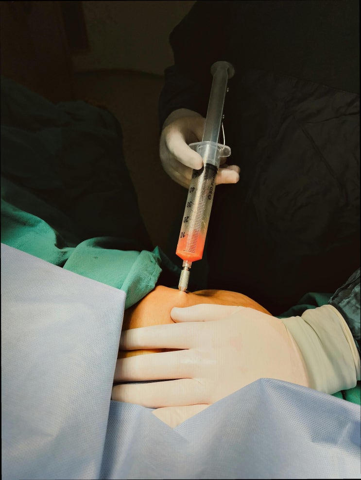  허벅지 지방분해주사 부작용 예방 및 붓기·멍 완화 방법