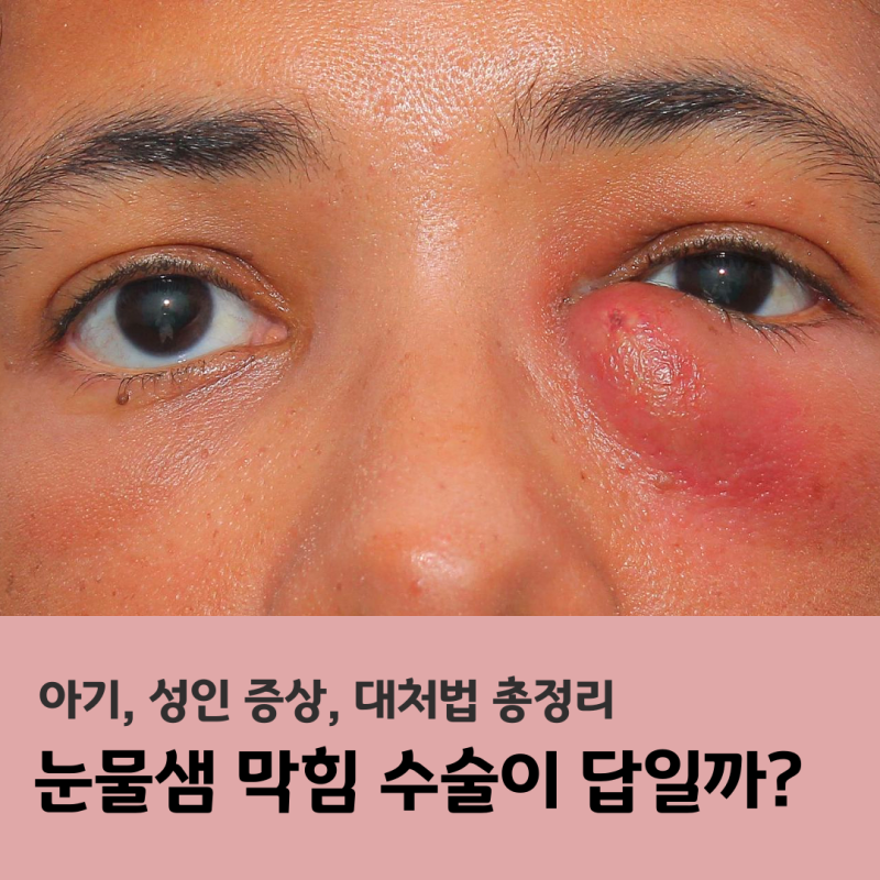 눈물샘 막힘 증상, 수술이 답일까? 대처법 총정리