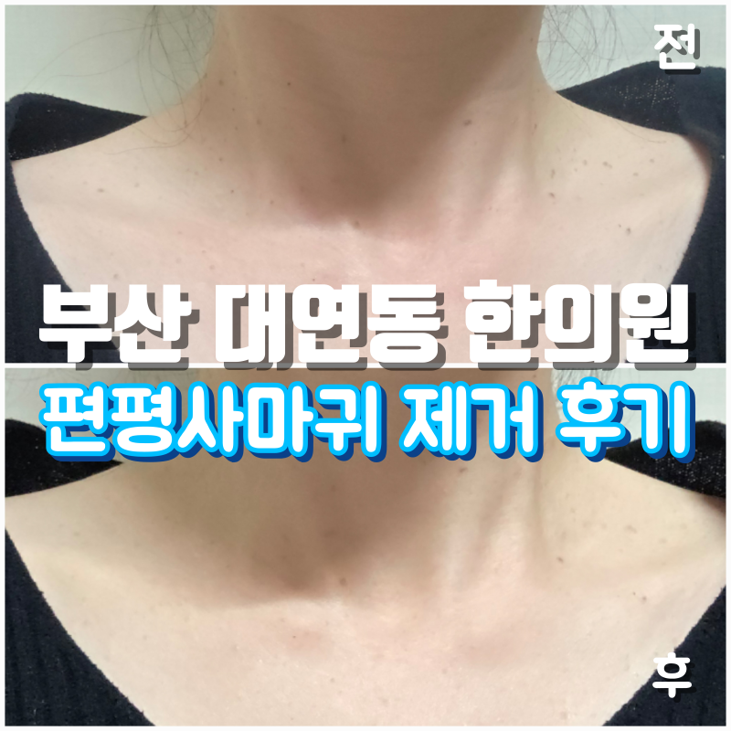 부산 편평사마귀 성지에서 제거 후기 및 주의사항, 대연동한의원